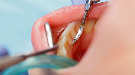 čiščenje zobnega kamna