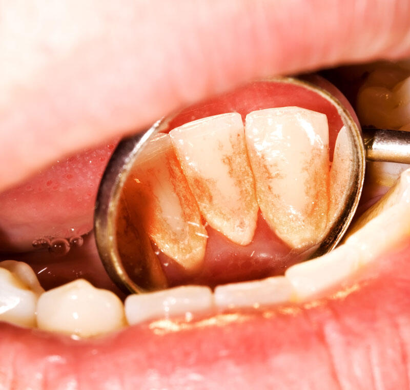 prednosti implantatov